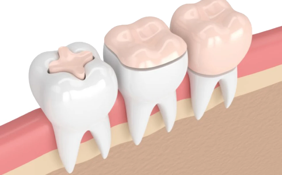 ZENith dental formation Les Inlay, Onlay, Overlay